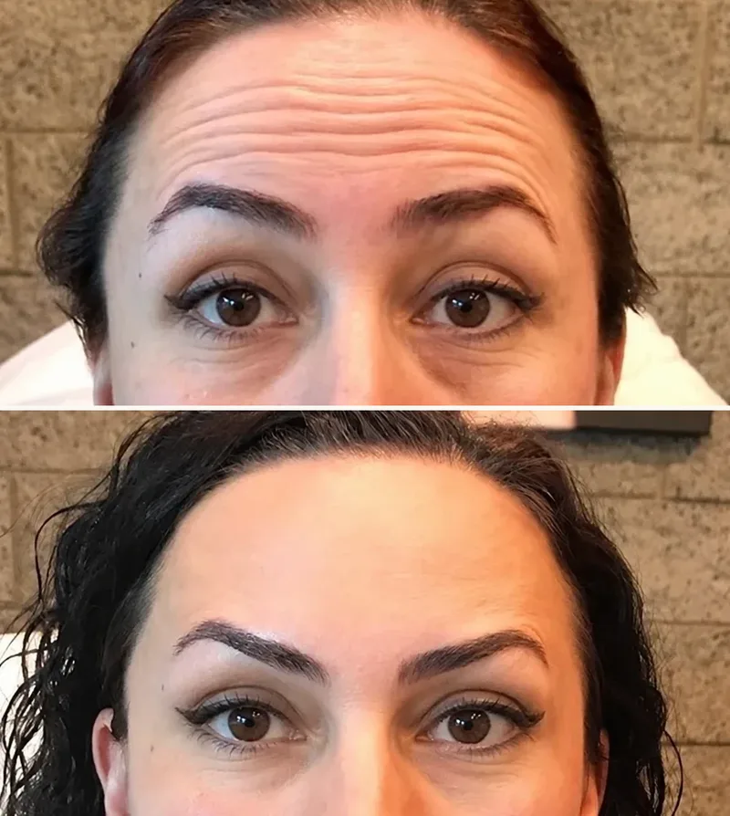 Beautiful Forehead