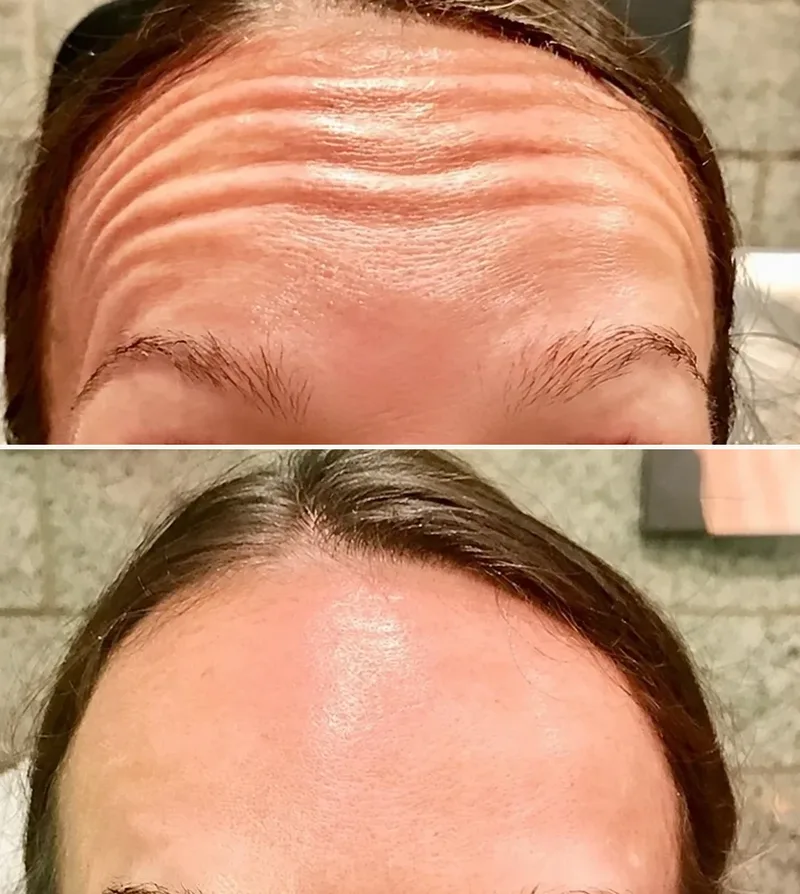 Forehead Wrinkles Removal