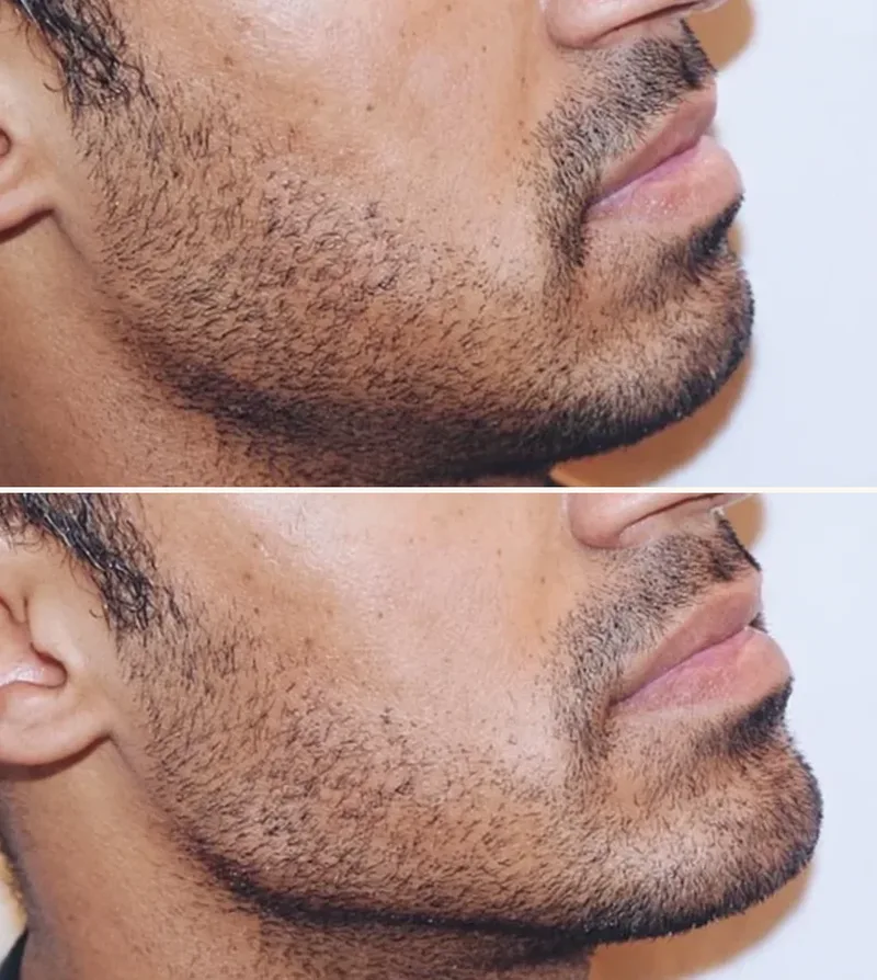 Defined Jaw