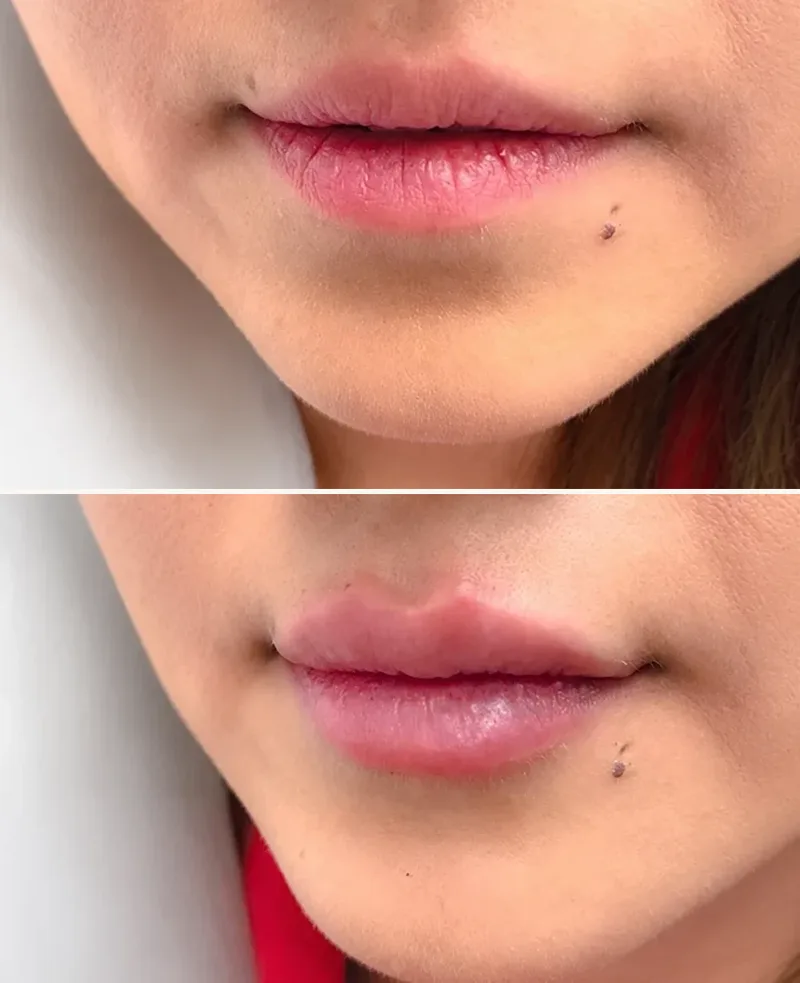 Fuller Lips