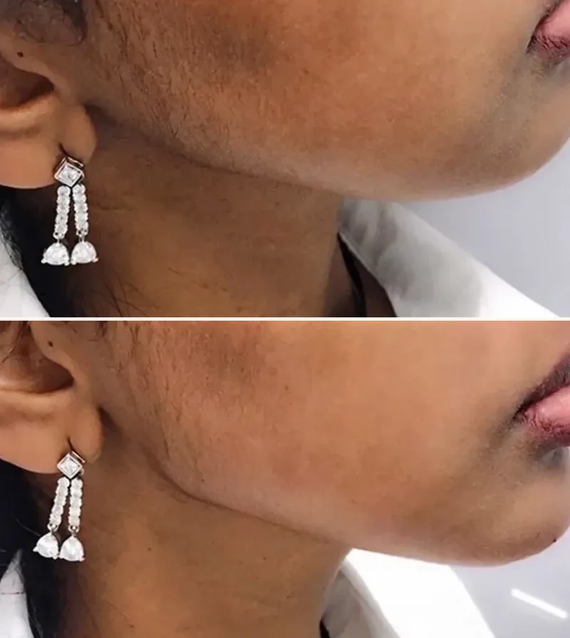 Jaw Before & After