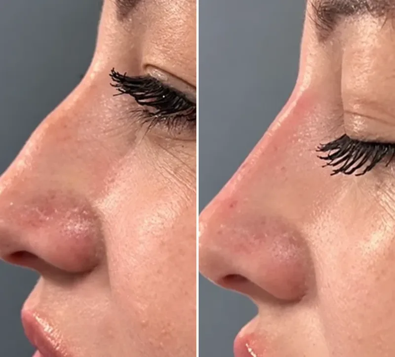 Before & After Nose