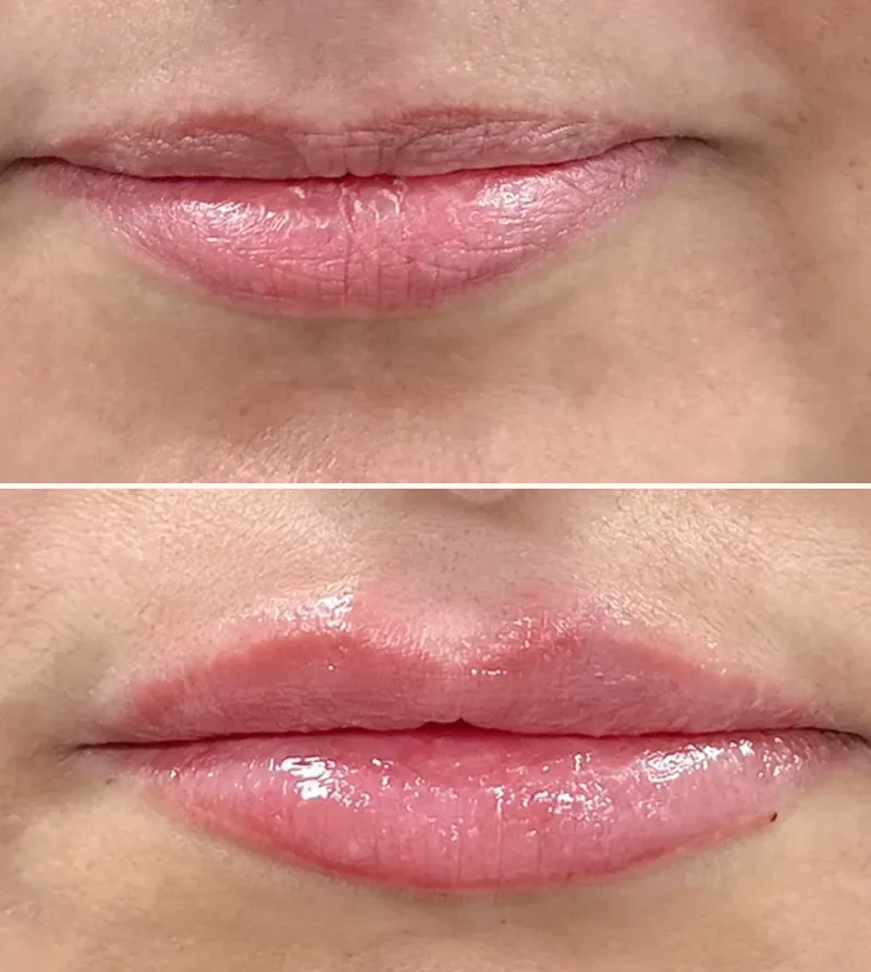 Dermal Fillers Lips Before/After
