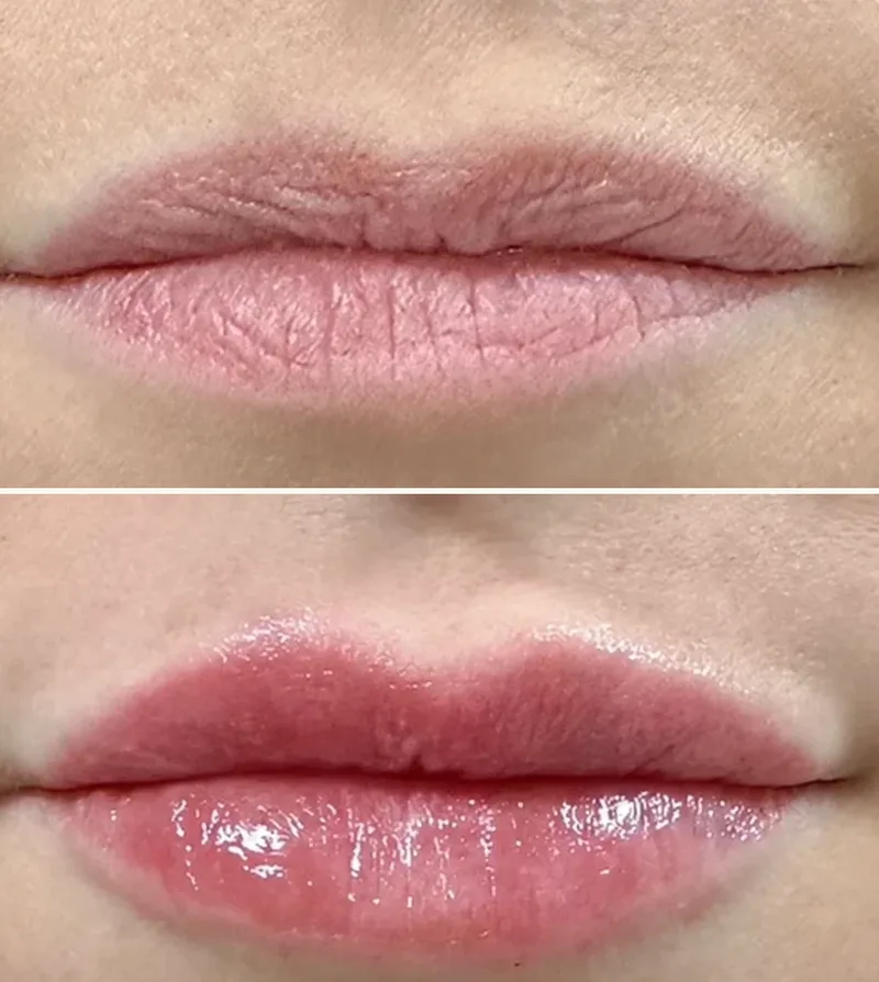Dermal Fillers