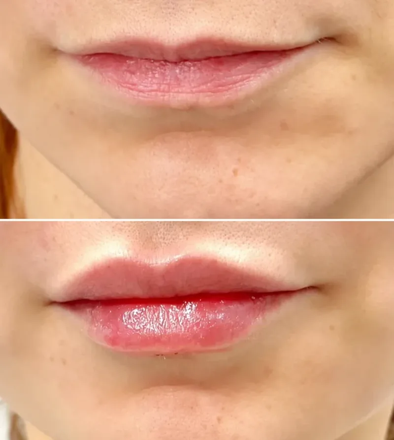 Dermal Fillers-Lips